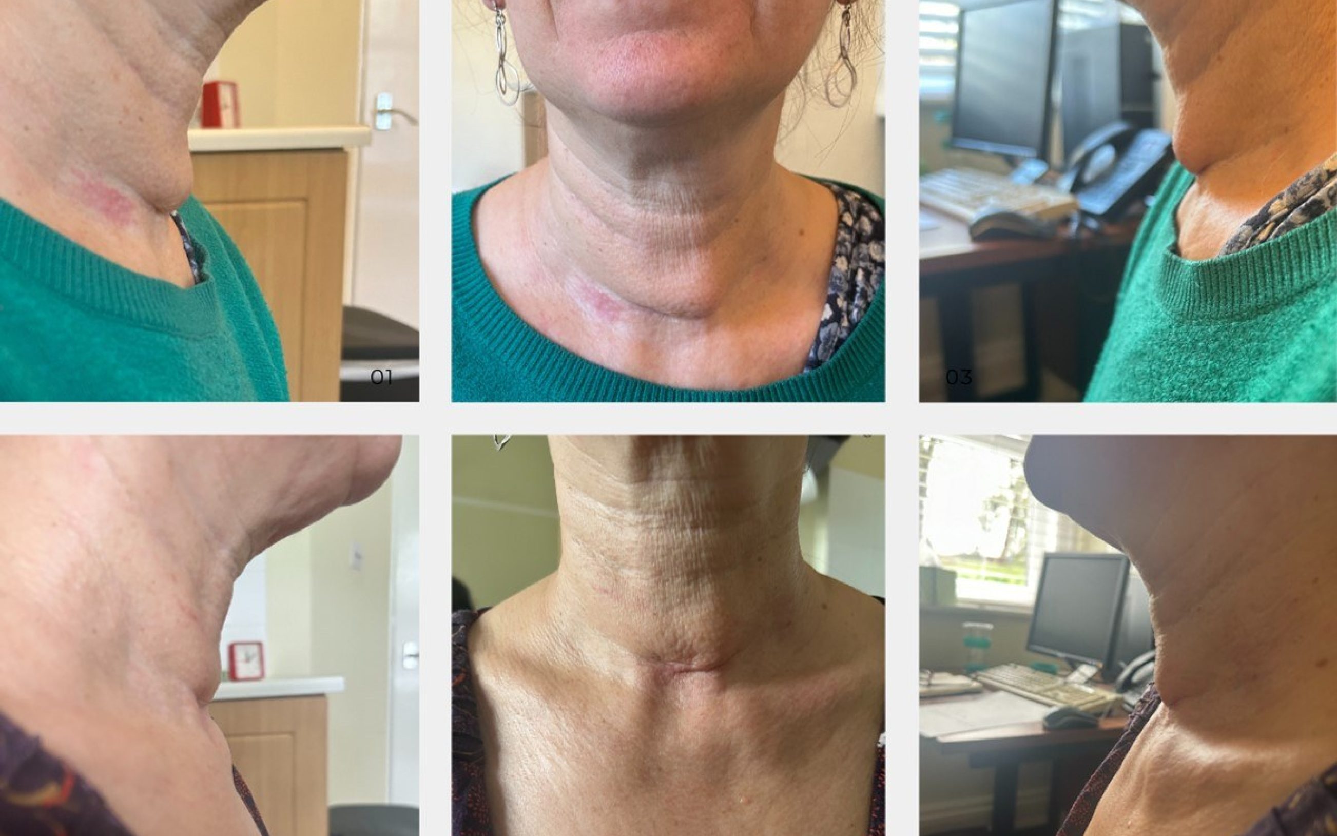 Scar Tissue Therapy